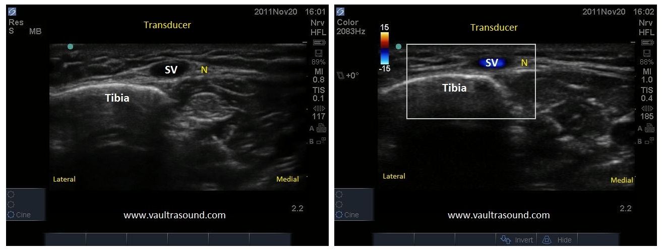 Ankle « VAULT