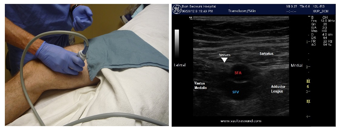 Adductor Canal / Saphenous « VAULT